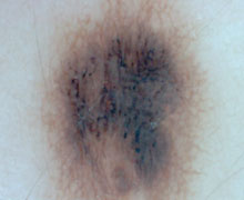 Aufnahme der Haut - Merkmal A: Asymmetrie