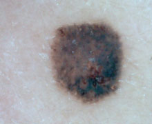 Aufnahme der Haut - Merkmal D: Durchmesser